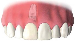 Crown seated on implant