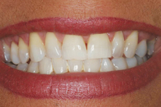 Tooth whitening Magherafelt